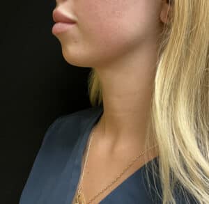 After Image: Before and After Using our Beautifill Laser Liposuction Device on the Chin Area