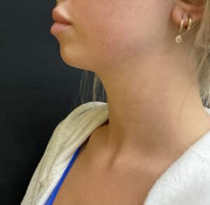 Before Image: Before and After Using our Beautifill Laser Liposuction Device on the Chin Area