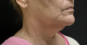 Before Image: Before and After Beautifill Laser Liposuction on Chin Area